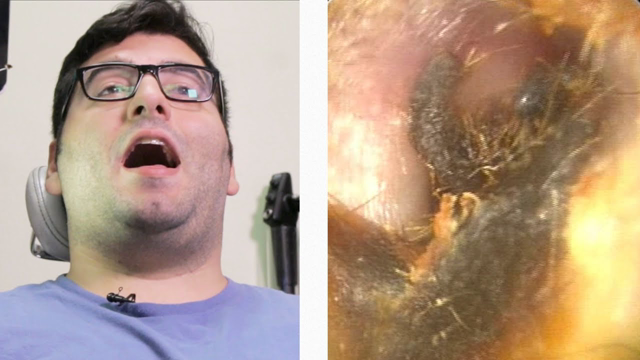 People Get Earwax Extractions For The First Time