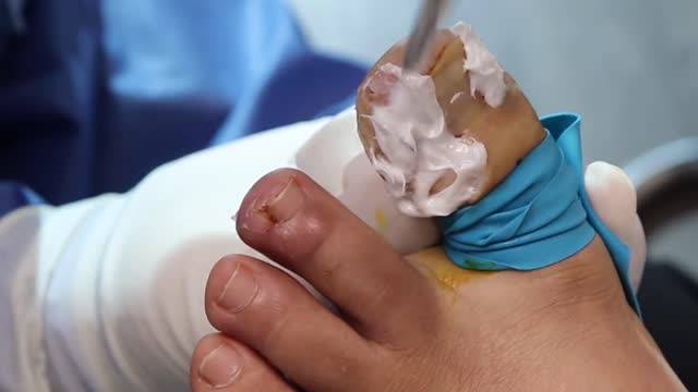 EXTREME INFECTED INGROWN TOENAIL REMOVAL ***WARNING GRAPHIC***