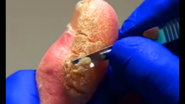 Cutting Out Thick Callus!  Peel Trigger "Peeling"