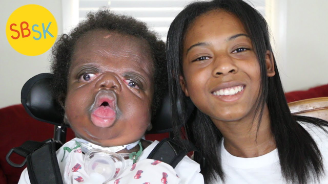 A King's Tale (Living with Beare-Stevenson Syndrome)