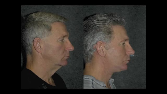 Male Facelift Before and After