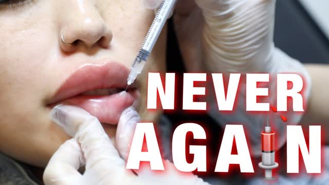 WHY I GOT MY LIP FILLER DISSOLVED