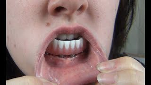 DENTAL IMPLANTS - MOST COMMON QUESTIONS | Bethany Wilhelm