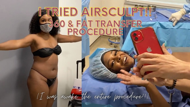 AirSculpt Full Procedure (360 + Fat Transfer) Review With Elite Body Sculpture