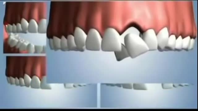 4 Options to Replace a Tooth