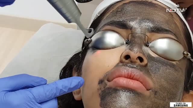 Carbon Spectra Treatment For A Glowing Skin | Hollywood Peel