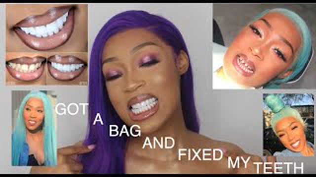 I HAD MY TEETH DONE IN TURKEY| VENEERS/ CROWNS | THE EXPERIENCE VLOG / Q&A