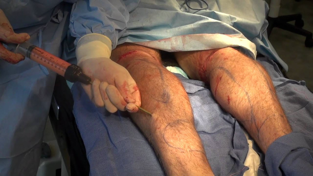 Male Bilateral Calf Implants - Advanced Medical Spa