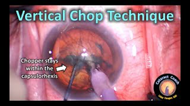 Learn the Vertical Chop Technique for Efficient Cataract Surgery