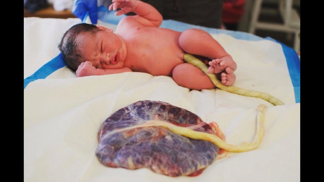 Arizona parents keep placenta attached to baby after birth