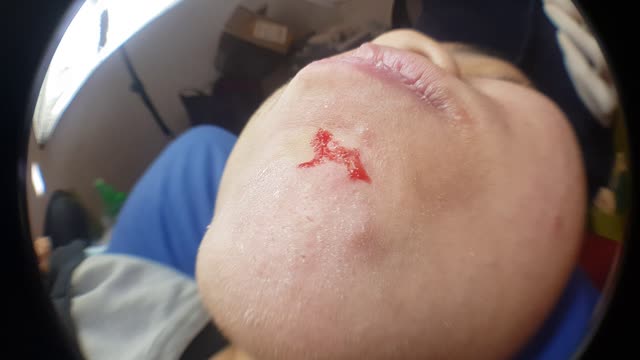 zits HD pimples blackhead gross #3