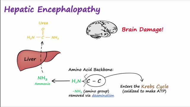 Hepatic Encephalopathy and Lactulose